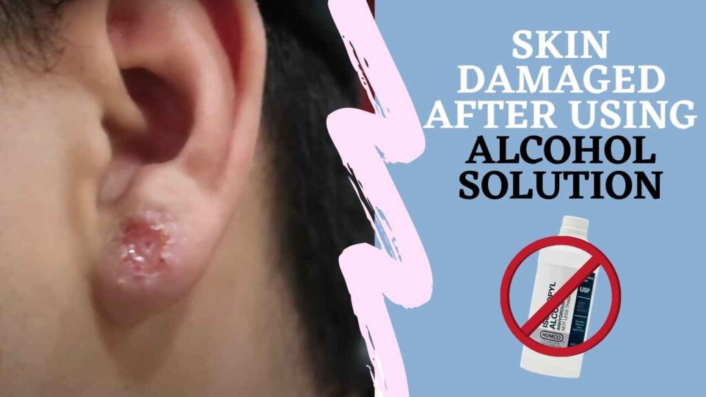 Can I use Alcohol to clean my Ear Piercing